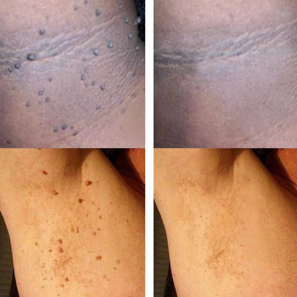 Non-Invasive Mole & Wart Pen - Image 3