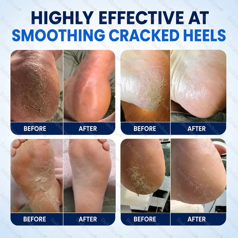 2% Salicylic Acid Callus & Cracked Heel Spray - Image 2