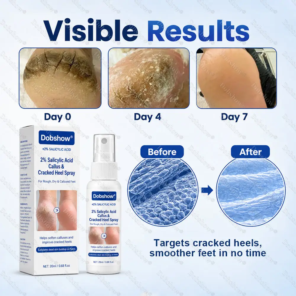 2% Salicylic Acid Callus & Cracked Heel Spray - Image 3