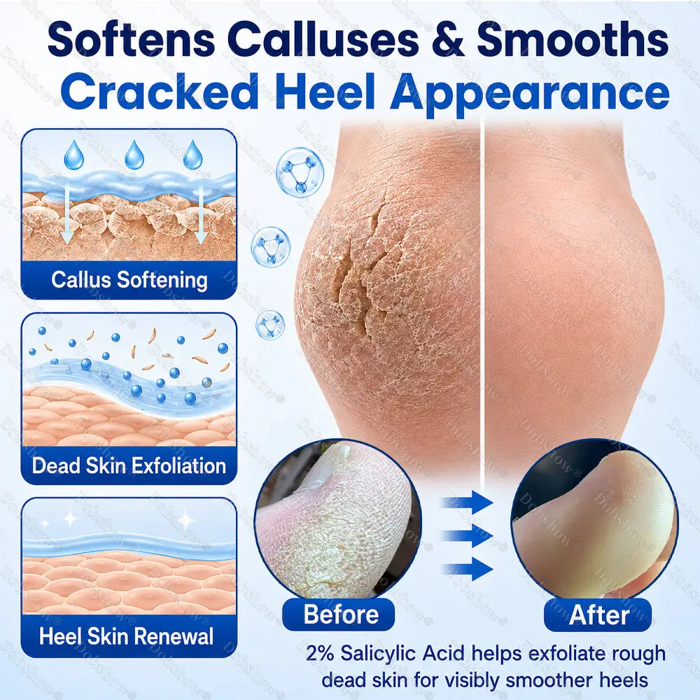 2% Salicylic Acid Callus & Cracked Heel Spray - Image 4