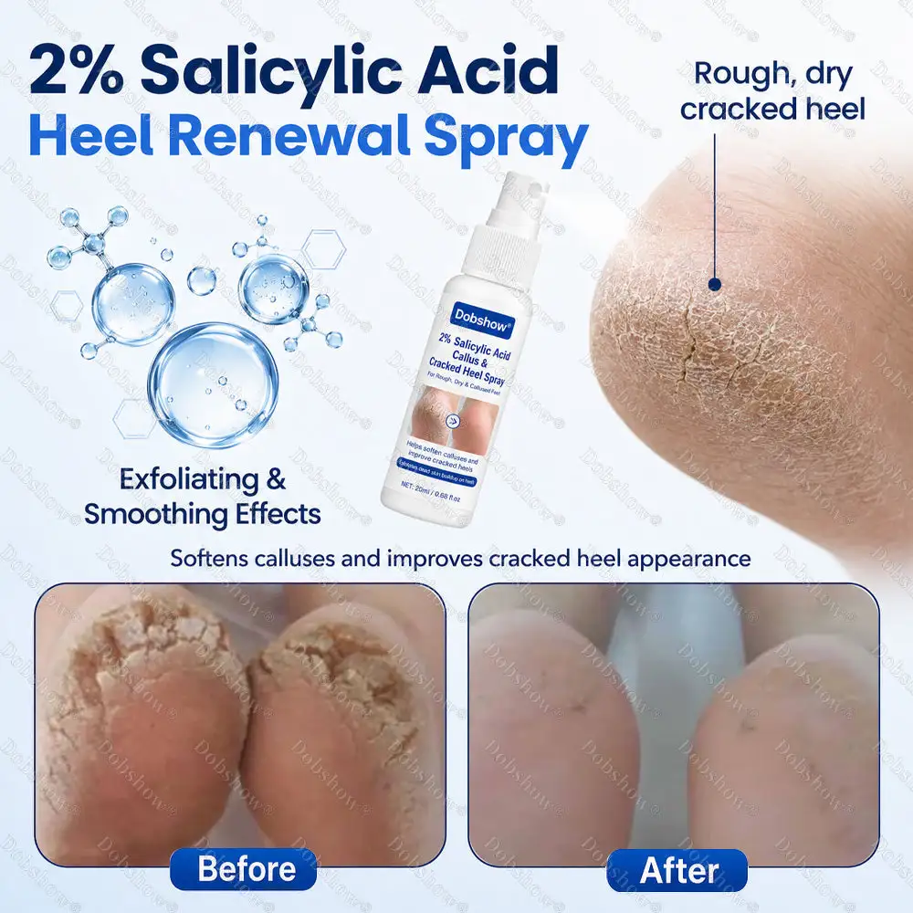 2% Salicylic Acid Callus & Cracked Heel Spray - Image 5