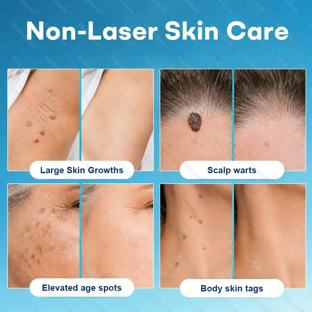 7 -Day Wart & Blemish Remover - Image 2